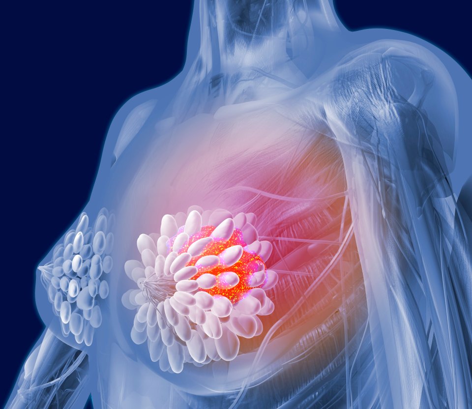 Illustration of breast cancer with a malignant tumor.