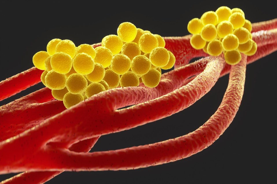Illustration of Staphylococcus aureus bacteria on human tissue.