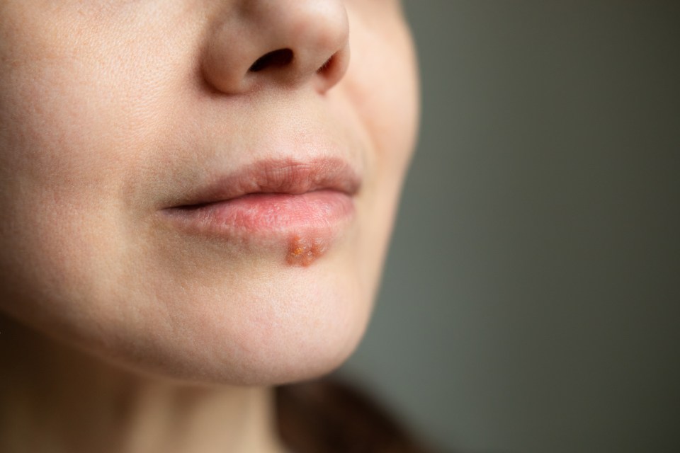 Close-up of a woman's lip with a cold sore.