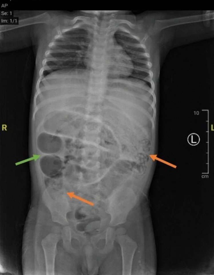 Abdominal X-ray showing masses in a toddler's abdomen.