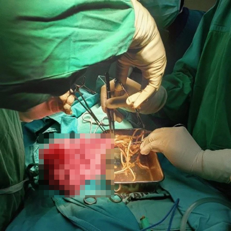 Surgical removal of worms from a toddler's intestines.