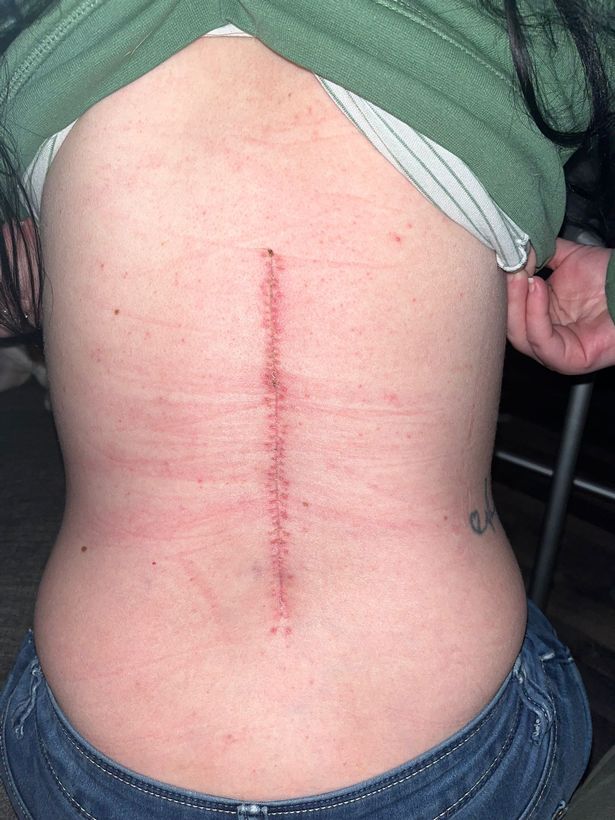 An image of a long red scar down a woman's back.