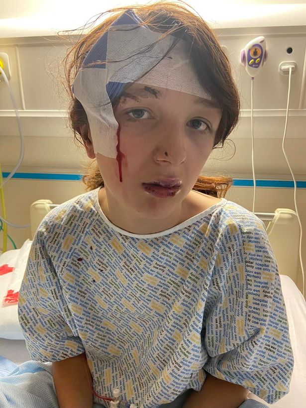 The then 12-year-old had to have a gash in her head glued back together