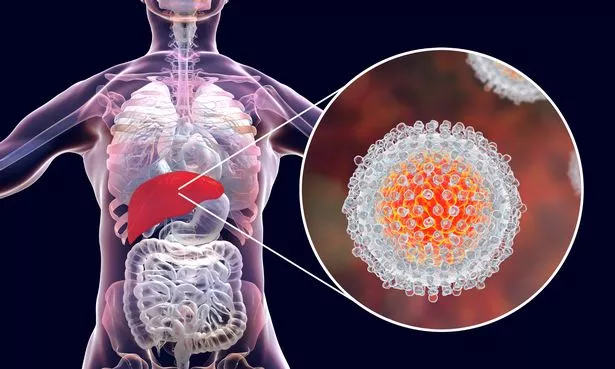 Hepatitis C virus can cause chronic liver disease,