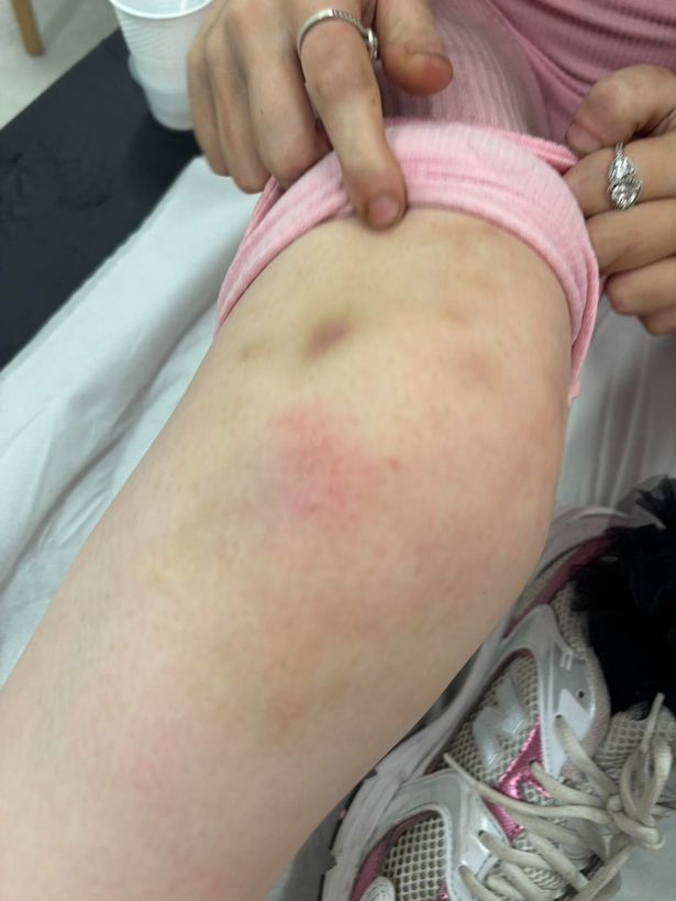 Caitlin suffered multiple bruises to her legs