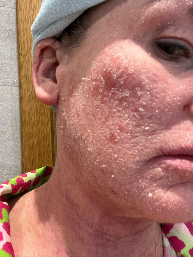 Karyn had been prescribed the creams since she was 10-years-old. 