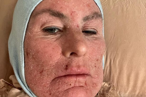 Karyn stopped using the creams three years ago. 