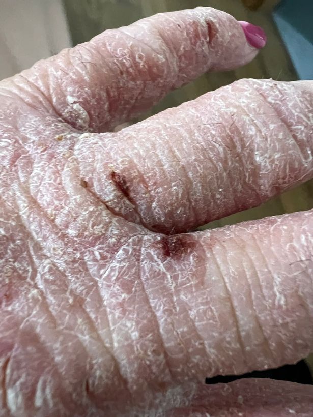 The Fife mum said her symptoms got worse after she stopped using the creams. 
