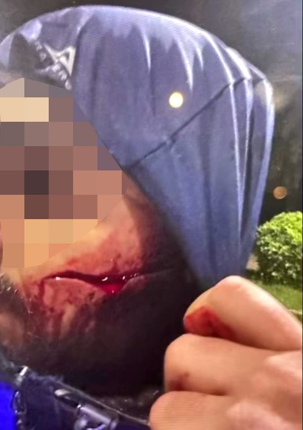 Blood seeps from the wound after the man was slashed in Thailand. 