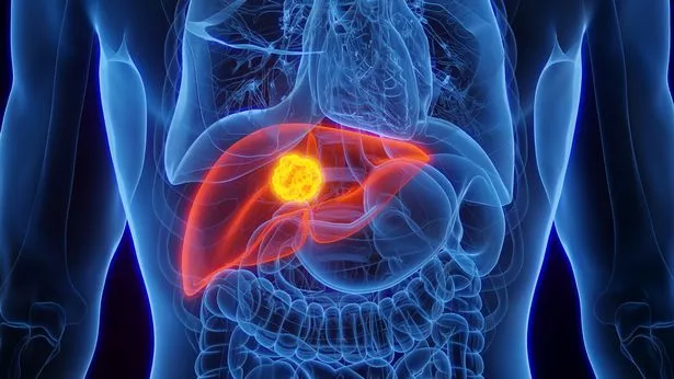 Liver cancer, illustration