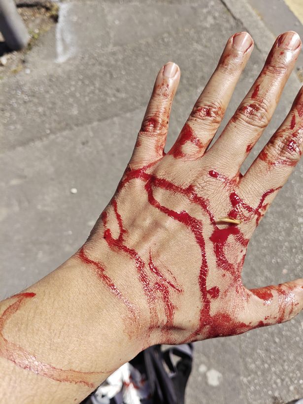 He blacked out after being struck with the butt of a water gun