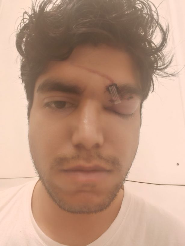Parth needed hospital treatment for his injuries