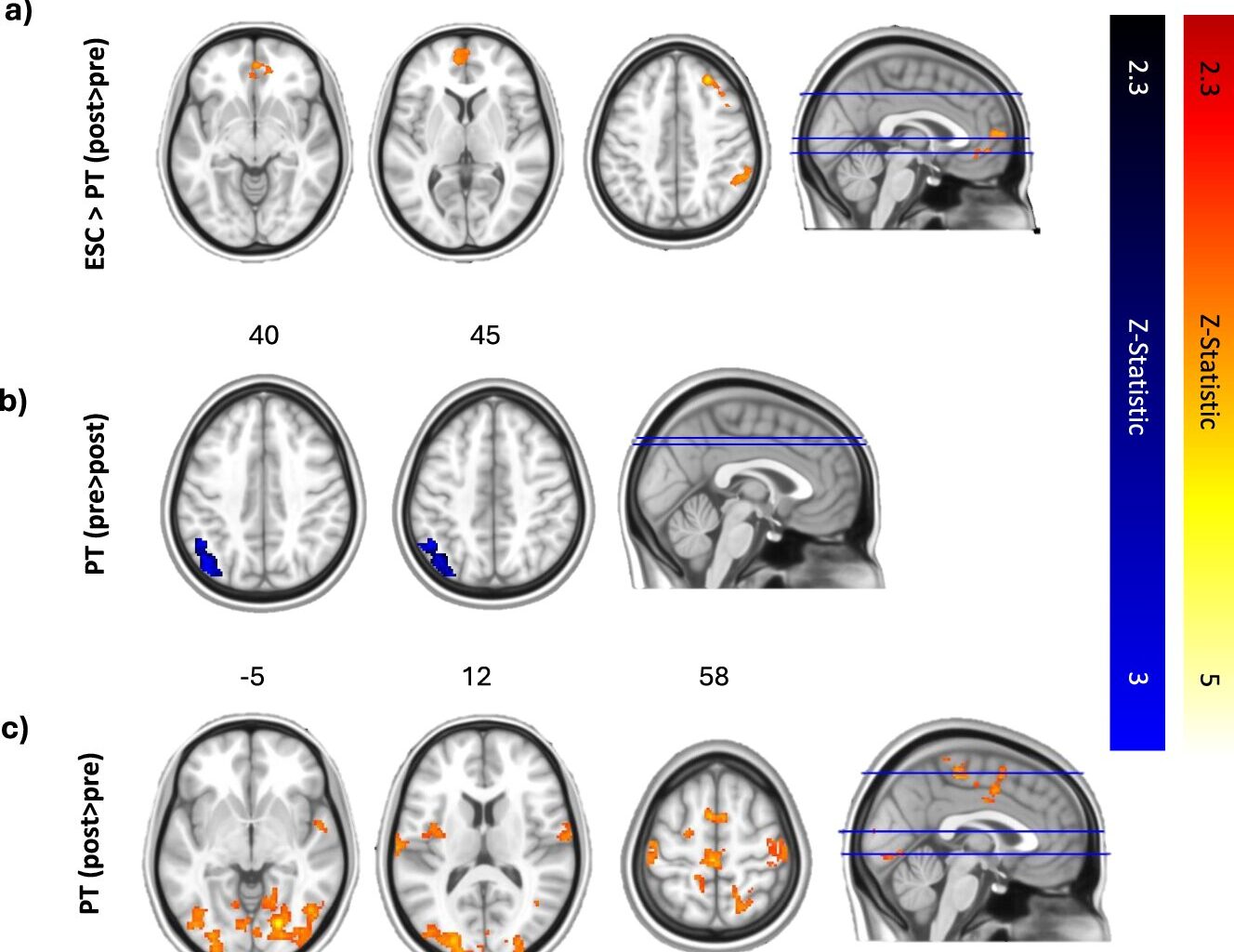 Psilocybin better preserves depressed patients' emotional response to music than standard drug, study finds