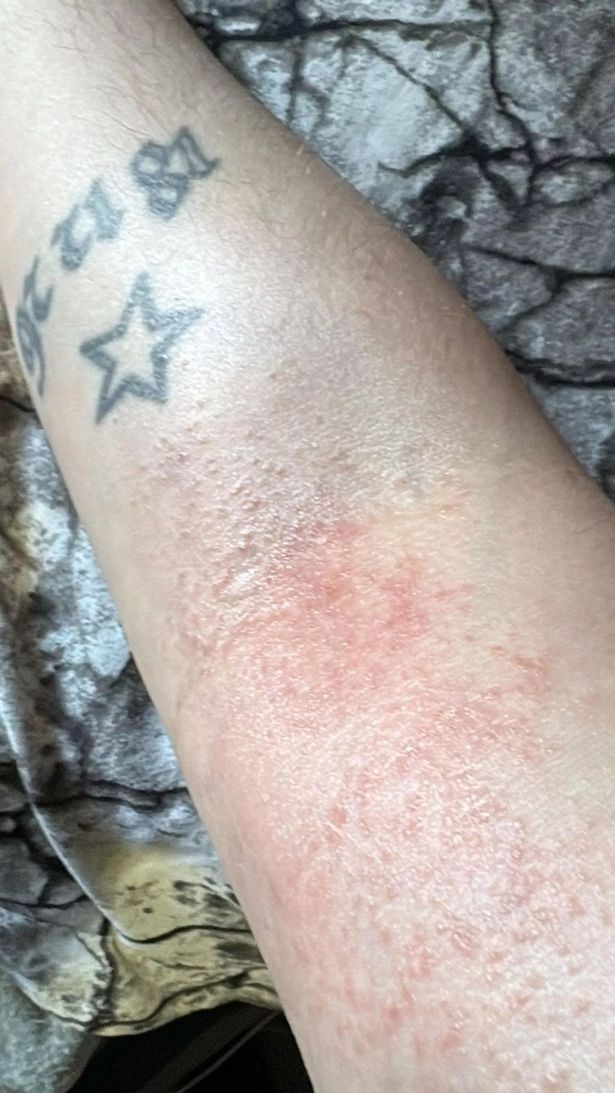 Jonathan has an infection from the mites