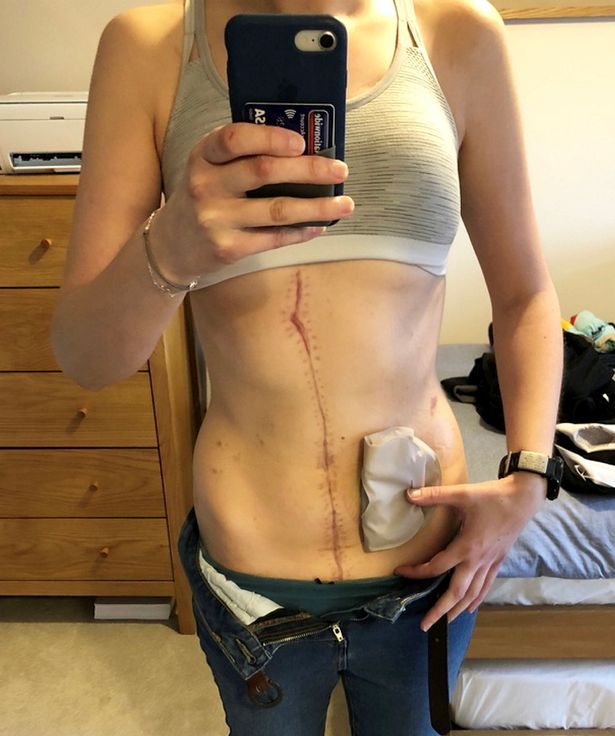 Rebecca Hind's scars