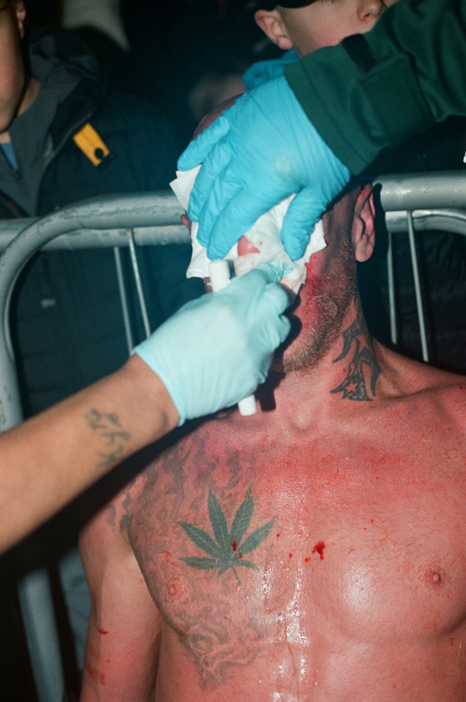 A man has his damaged nose attended to