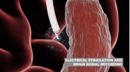 Computer generated image of tiny cranial catheter entering brain tissue