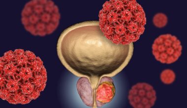 Genomic vs Genetic Testing in Prostate Cancer