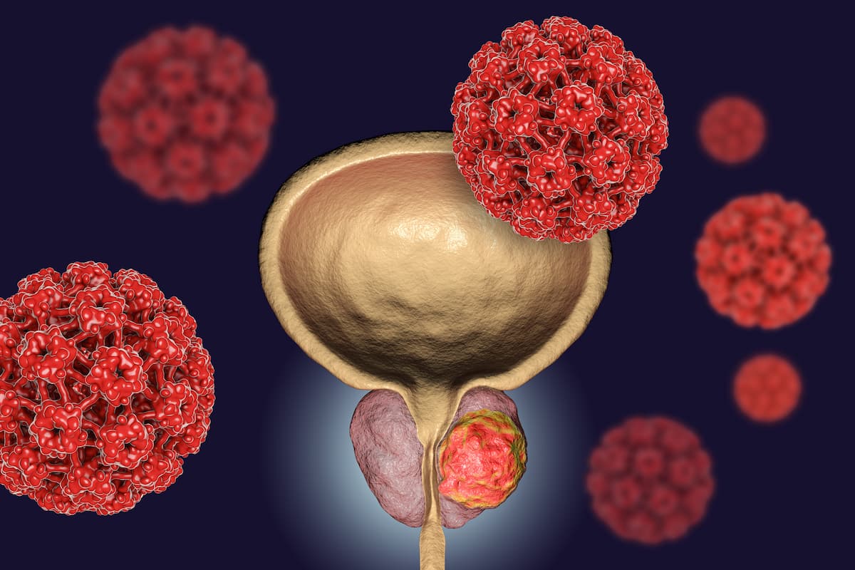 Genomic vs Genetic Testing in Prostate Cancer