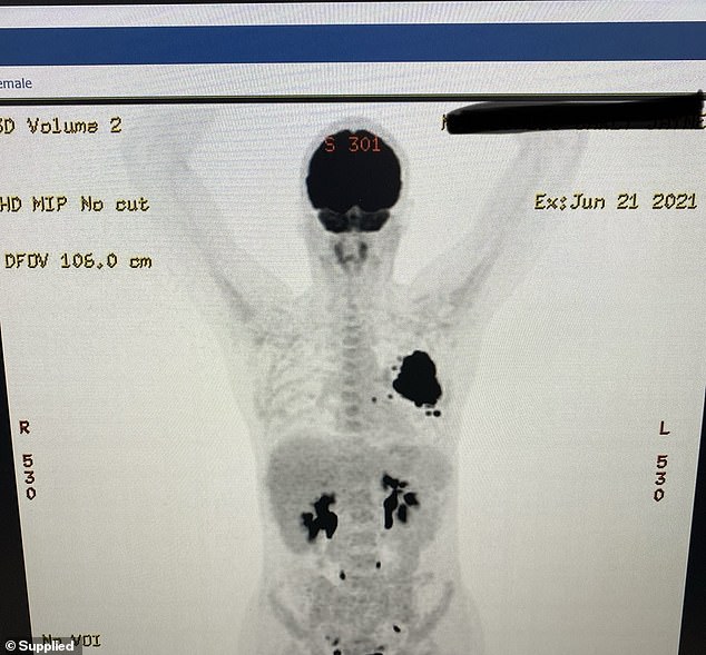 Carly, from Newcastle, NSW, underwent scans in 2021 that immediately revealed a large mass around her left upper lung