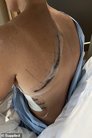 In 2022, doctors operated to remove the tumour, along with other affected parts of the lung