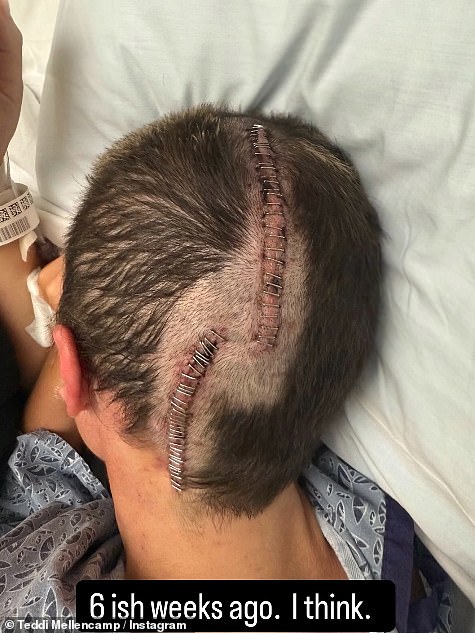 In February, Teddi underwent emergency brain surgery and was given a '50-50' chance of survival