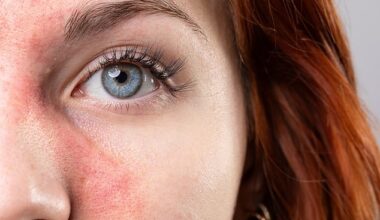 Rosacea is estimated to affect around three million people in the UK ¿ predominantly those with fair skin
