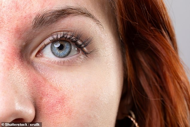 Rosacea is estimated to affect around three million people in the UK ¿ predominantly those with fair skin