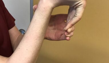 The connective tissue is 'the glue' of the body and when weakened, allows a person to bend their fingers or palm beyond a normal range of motion