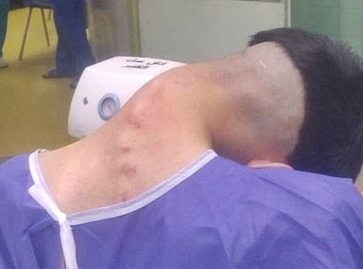 Dropped head syndrome is a rare medical disorder, where the neck muscles become so weak they can no longer support the head