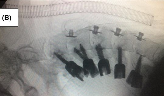 Post-operative CT scan showing screws used to stabilise the neck