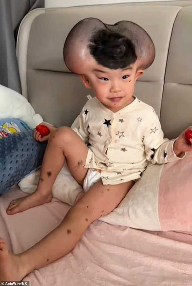 Picture shows the three-year-old Qibao who was teased for looking like Mickey Mouse due to a rare skin condition that led to him having two massive growths on his head