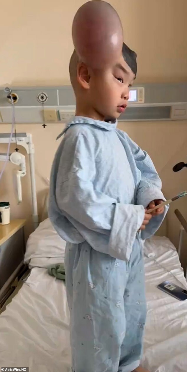 Pre-operation video footage shared on social media by Qibao's family shows the large balloon-like newly-grown skin on both sides