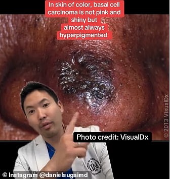 For people of colour, a bump will grow and become darker than the surrounding skin, the top dermatologist said