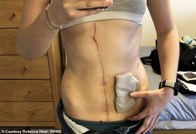 The former outdoor instructor Rebecca's scars and weight loss after a surgery