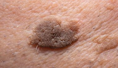 Because these patches are benign and don’t become cancerous, removal is usually considered cosmetic and not funded by the NHS