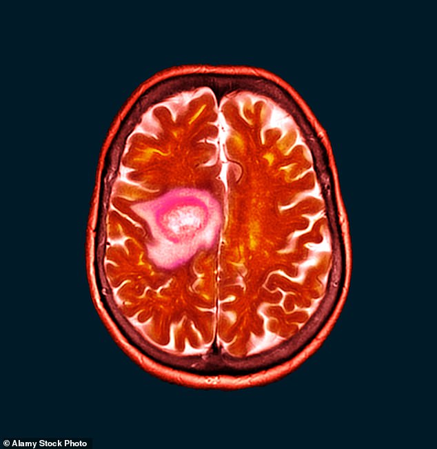 But a study, published last year, revealed women who had used it for more than a year were five times more likely to suffer a meningioma, a type of brain tumour (Stock Image)
