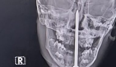 Seven-year-old boy has three-inch nail removed from his BRAIN by incredible surgeons after he fell on it in horrific India playtime accident