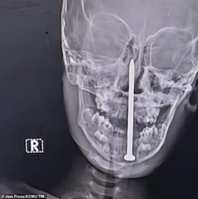 Seven-year-old boy has three-inch nail removed from his BRAIN by incredible surgeons after he fell on it in horrific India playtime accident