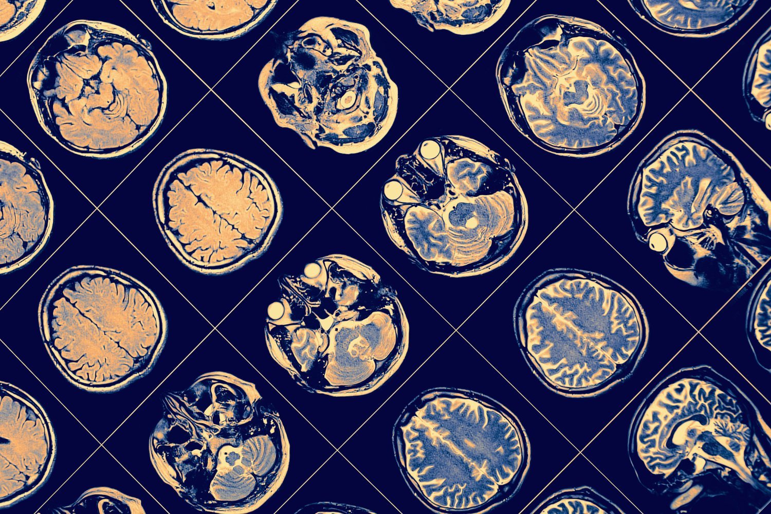 Hundreds of people in Canada are suspected to have come down with an unknown brain disease. But a new report suggests otherwise.