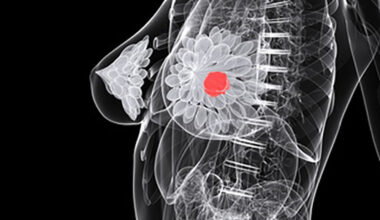 Outline X-ray type illustration of a woman with breast cancer.