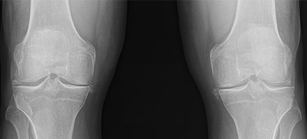 A groundbreaking study has uncovered new genetic links to calcium pyrophosphate deposition (CPPD) disease, a common type of inflammatory arthritis. This image shows an X-ray revealing chondrocalcinosis (radiographic evidence of CPPD) in the cartilage of both knees. CREDIT: Sara Tedeschi 