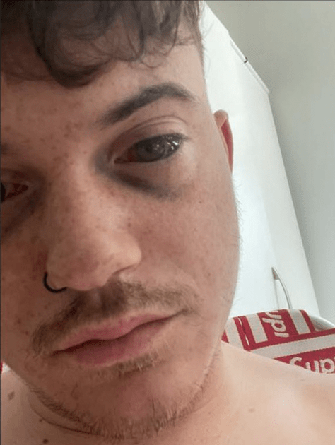 Close-up of a young man with a black eye.