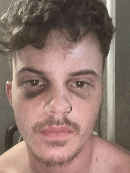 Close-up of a young man with a black eye.