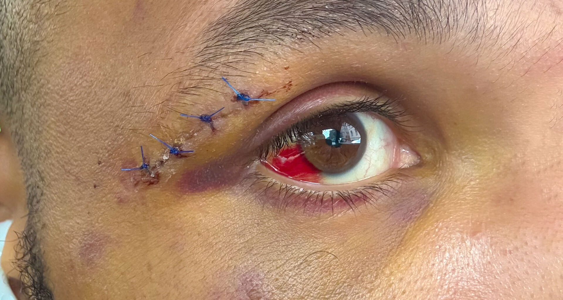 Chris Eubank Jr shows off horror bloodied eye on set of hit Netflix show after 'almost dying' in Conor Benn fight