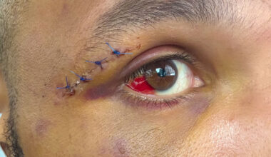 Chris Eubank Jr shows off horror bloodied eye on set of hit Netflix show after 'almost dying' in Conor Benn fight