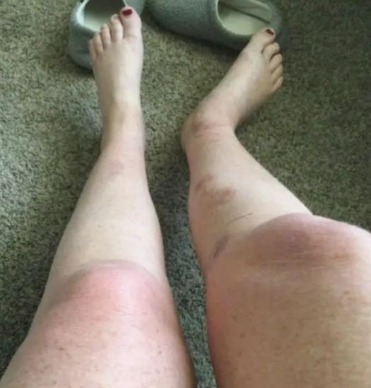 Photo of legs with bruises and scrapes.
