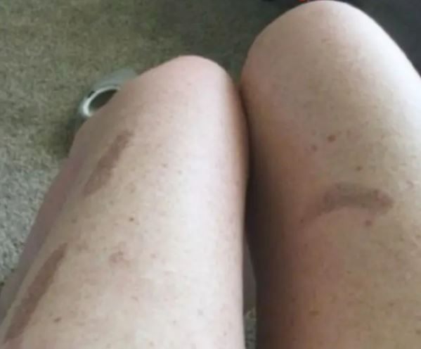 Photo of legs with large bruises.
