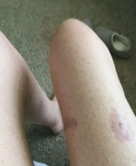 Photo of legs with bruises and scarring.