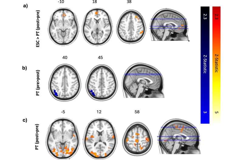 How the treatment of depression with psilocybin and escitalopram affects how people process music
